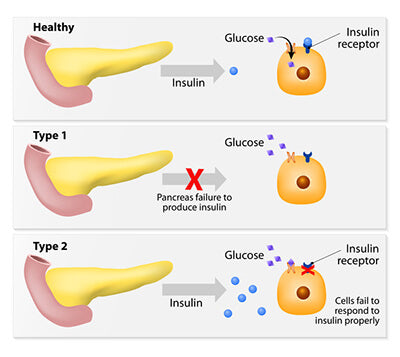 Why Was Sweet Urine Historically Linked to Diabetes?